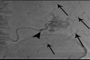 Intractable parastomal bleeding in a portal hypertensive patient managed by direct sclerotherapy: A case report