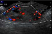 Post-Molar Stage I Low-Risk Gestational Trophoblastic Neoplasia: Transvaginal Ultrasound Findings and Their Correlation with Chemotherapy Response