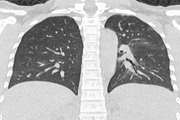 CT Findings of Pregnant Women With Coronavirus Disease (COVID-19) Pneumonia