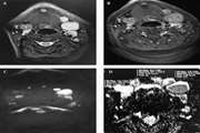 Diagnostic efficacy of diffusion-weighted magnetic resonance imaging (DWI) in the differentiation of benign and malignant cervical lymphadenopathies