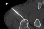 Management of Osteoid Osteoma Using Radiofrequency Ablation