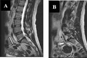 Frequency Of abnormal findings in lumbar MRI In patients With Non traumatic and non surgical low back pain referred to Imam Khomeini Hospital