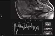 Improved Diagnostic Accuracy in Characterization of Adnexal Masses by Detection of Choline Peak Using 1H MR Spectroscopy in Comparison to Internal Reference at 3 Tesla