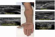 The Best Cutoff Point for Median Nerve Cross Sectional Area  at the Level of Carpal Tunnel Inlet 