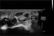 Application of ultrasound elastography for determining carpal tunnel syndrome severity