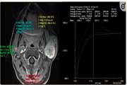 Dynamic contrast-enhanced MRI for differentiation of major salivary glands neoplasms, a 3-T MRI study