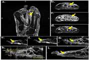 Systematic bone infection detection in axial diabetic foot MRI  (Conference Paper)