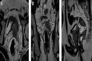 The Value of Prostate MRI with Endorectal Coil in Detecting Seminal Vesicle Involvement in Patients with Prostate Cancer