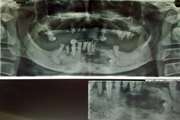 Intraosseous Pleomorphic Adenoma of the Mandible