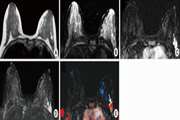 Magnetic Resonance Imaging Features of Adenosis in the Breast