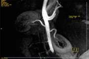 Renal Sympathetic Denervation by CT-scan-Guided Periarterial Ethanol Injection in Sheep