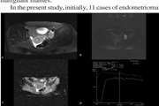 Differentiation of benign from malignant adnexal masses by functional 3 tesla MRI techniques: diffusion-weighted imaging and time-intensity curves of dynamic contrast-enhanced MRI