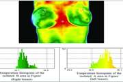 Assessing the Potential of Thermal Imaging in Recognition of Breast Cancer