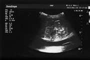 Inferior Epigastric Artery Pseudoaneurysm Following Paracentesis in a Liver Graft Recipient: A Case Report