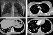 Coil Embolotherapy of Unilateral Diffuse Pulmonary Arteriovenous Malformations in a Nineteen-Year-Old Woman