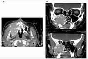 Primary Hyperparathyroidism Misdiagnosed as Giant Cell Bone Tumor of Maxillary Sinus: A Case Report