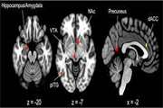 Exploring Neural Correlates of Different Dimensions in Drug Craving Self-Reports among Heroin Dependents