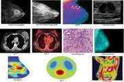 Breast cancer diagnosis by thermal imaging in the fields of medical and artificial intelligence sciences: Review article