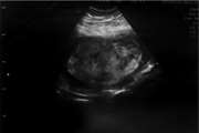 A case report of partial molar pregnancy associated with a normal appearing dizygotic fetus