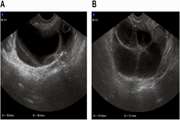 Ovarian hyperstimulation syndrome followed by ovarian torsion in premenopausal patient using adjuvant tamoxifen treatment for breast cancer  