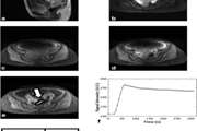 Semiquantitative dynamic contrast-enhanced MRI for accurate classification of complex adnexal masses