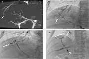 Percutaneous Transhepatic N-Butyl Cyanoacrylate Injection Therapy of an Isolated Bile Duct Associated with a Bronchobiliary Fistula