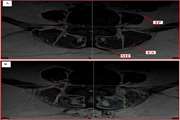 Cross-sectional area of human trunk paraspinal muscles before and after posterior lumbar surgery using magnetic resonance imaging