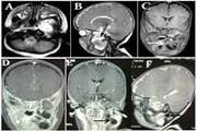 Infratemporal fossa glial choristoma (Heterotopia): A rare presentation  