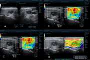 Application of Sonoelastography in Differential Diagnosis of Benign and Malignant Thyroid Nodules