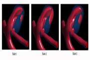 Effects of Variations of Flow and Heart Rate on Intra-Aneurysmal Hemodynamics in a Ruptured Internal Carotid Artery Aneurysm During Exercise