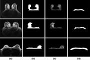 Localized-atlas-based segmentation of breast MRI in a decision-making framework