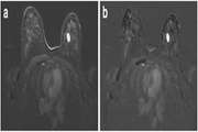 Computer-aided detection of breast lesions in DCE-MRI using region growing based on fuzzy C-means clustering and vesselness filter