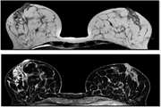 Diagnostic investigation of breast magnetic resonance imaging in malignant and benign mass lesions