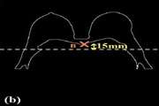 Breast-region segmentation in MRI using chest region atlas and SVM