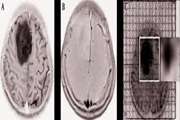 Efficacy of 1H-MRSI and DWI for Non-invasive Grading of Brain Gliomas