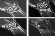 Comparison of Quantitative Assessment of BLADE and Isotropic Three-Dimensional Fast Spin Echo Cube (3D T2 SPACE) Sequences with Conventional Protocols of wrist Joint at 3 Tesla Magnetic Resonance Imaging