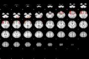 The Human Olfactory System: Cortical Brain Mapping Using fmri