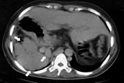 Extensive Gastroesophageal Varices in a Non-Cirrhotic Female with Left Isomerism: A Case Report and Literature Review