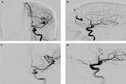 Embolization of Intracranial Arteriovenous Malformations Using Onyx in 53 Patients