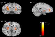 Lower Gray Matter Density in the Anterior Cingulate Cortex and Putamen Can Be Traceable in Chronic Heroin Dependents After Over Three Months of Successful Abstinence