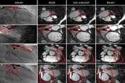 Diagnostic Efficacy of Coronary Artery Three-Dimensional Steady-State Free Precession Magnetic Resonance Angiography in Comparison with Invasive Coronary Angiography for Detecting Coronary Artery Disease