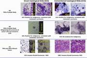 Microfluidic platform with integrated electrical actuator to enrich and locating atypical/cancer cells from liquid cytology samples