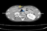 Pheochromocytoma in a patient with heterotaxy syndrome: a case report