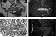 Advanced MRI prediction model for anatomical site identification in uterine carcinoma: enhancing diagnostic accuracy