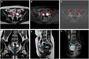	Refining MRI protocols for endometriosis: a comparative study of abbreviated and full MRI sequences