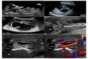 Ultrasonography and Magnetic Resonance Imaging in a Fetus with Sacrococcygeal Teratoma: A Case Report