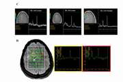 Magnetic Resonance Spectroscopy Findings of Intracranial Chondroma and Chondrosarcoma with a Non-Skull Base Origin: A Report of Two Cases