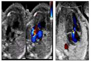 Evaluation of fetal cardiac anomalies and their outcomes in isolated cardiac anomalies and non-isolated groups and based on minor and major abnormalities