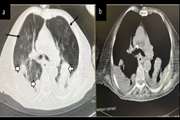 Role of chest CT scan in patients with preexisting cancer and COVID-19 pneumonia