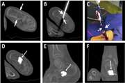 Treatment of a calcaneal unicameral bone cyst by percutaneous CT guided cement injection using a double needle technique: A case report